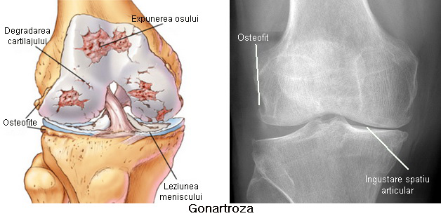 impotenta functionala articulara dureri în articulațiile genunchiului și