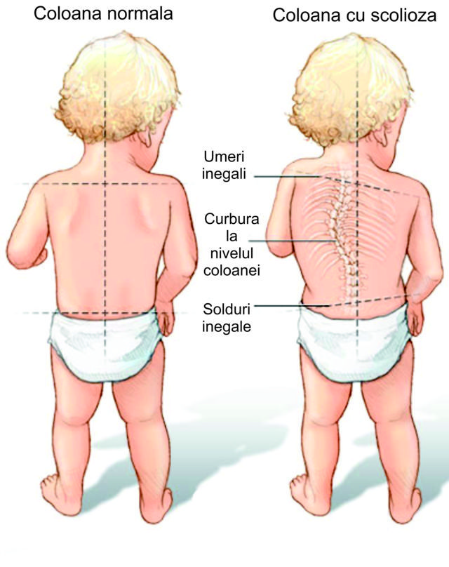 balance Pathological Rely on Deviațiile coloanei vertebrale la copii | Centrul medical de recuperare